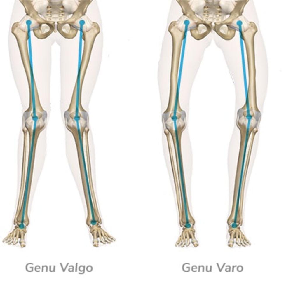 What’s New in Limb Lengthening and Deformity Correction
